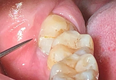 Nhổ răng khôn kiêng gì và ăn gì để không đau, nhanh khỏi